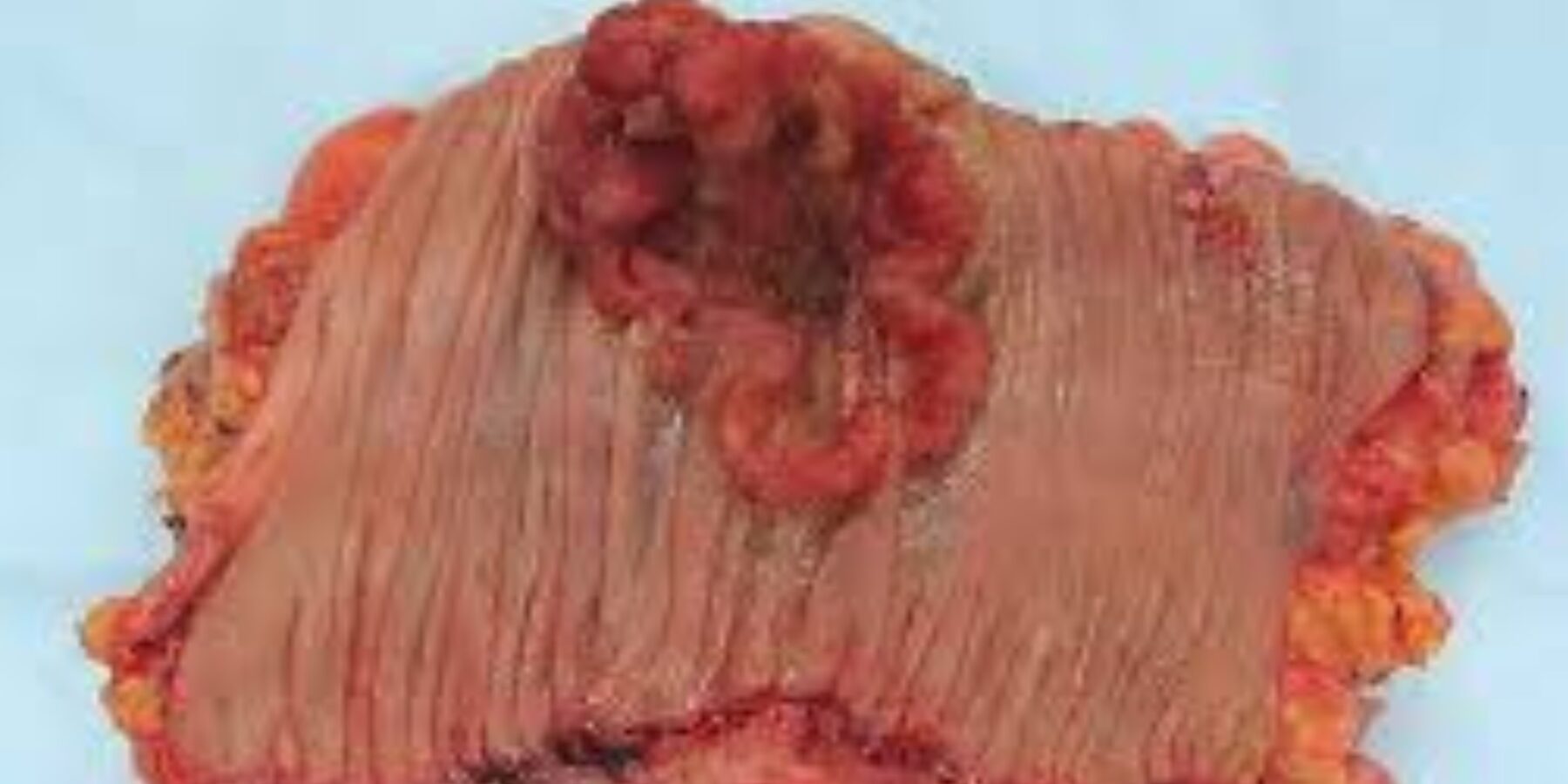 Фахівці попереджають: симптоми колоректального раку варто знати кожному