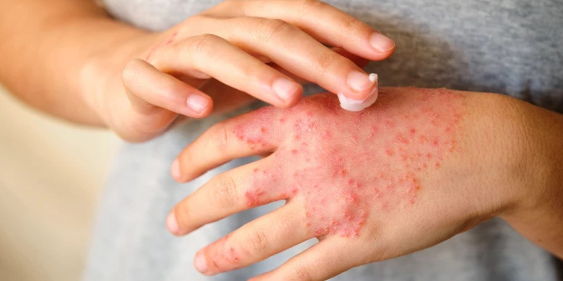 Як стрес запускає екзему: нове відкриття вчених