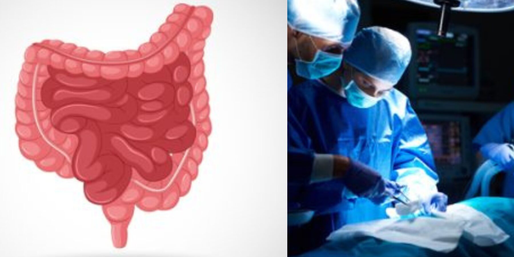Несвоєчасне розпізнавання ішемії кишківника призводить до смерті