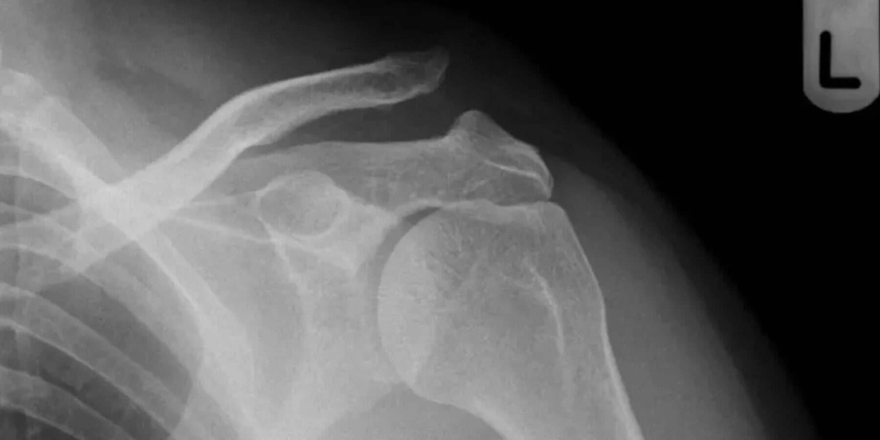 Фахівці пояснили, що означає «випала ключиця»