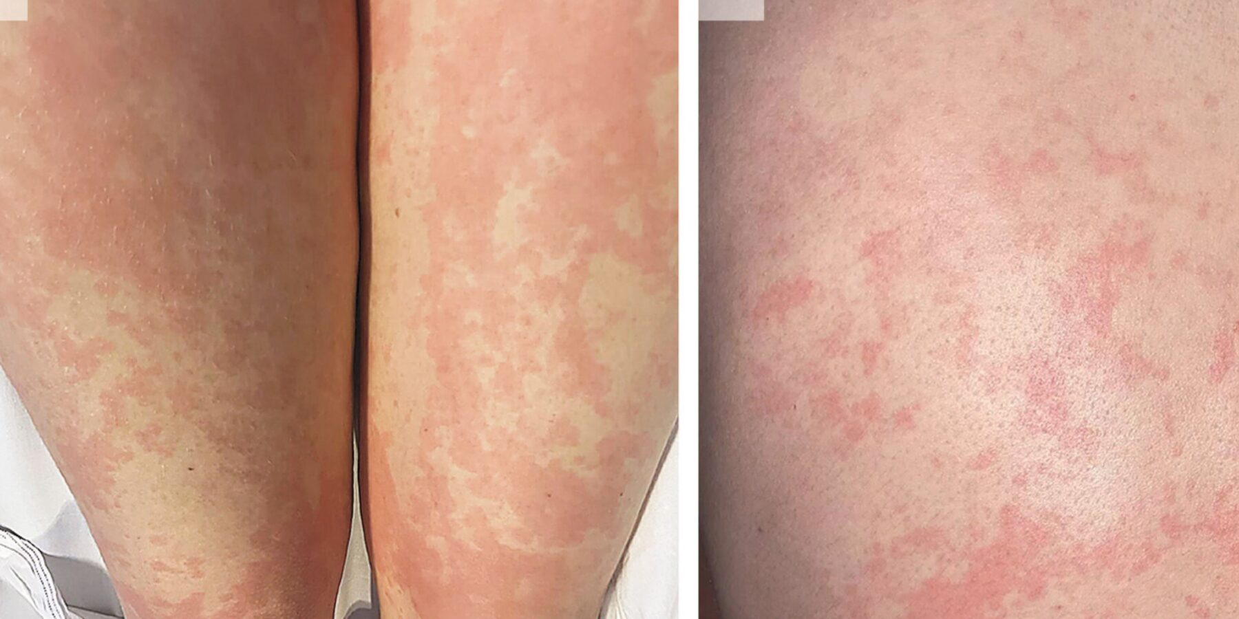 Вчені виявили захворювання, раніше невідоме світовій медицині