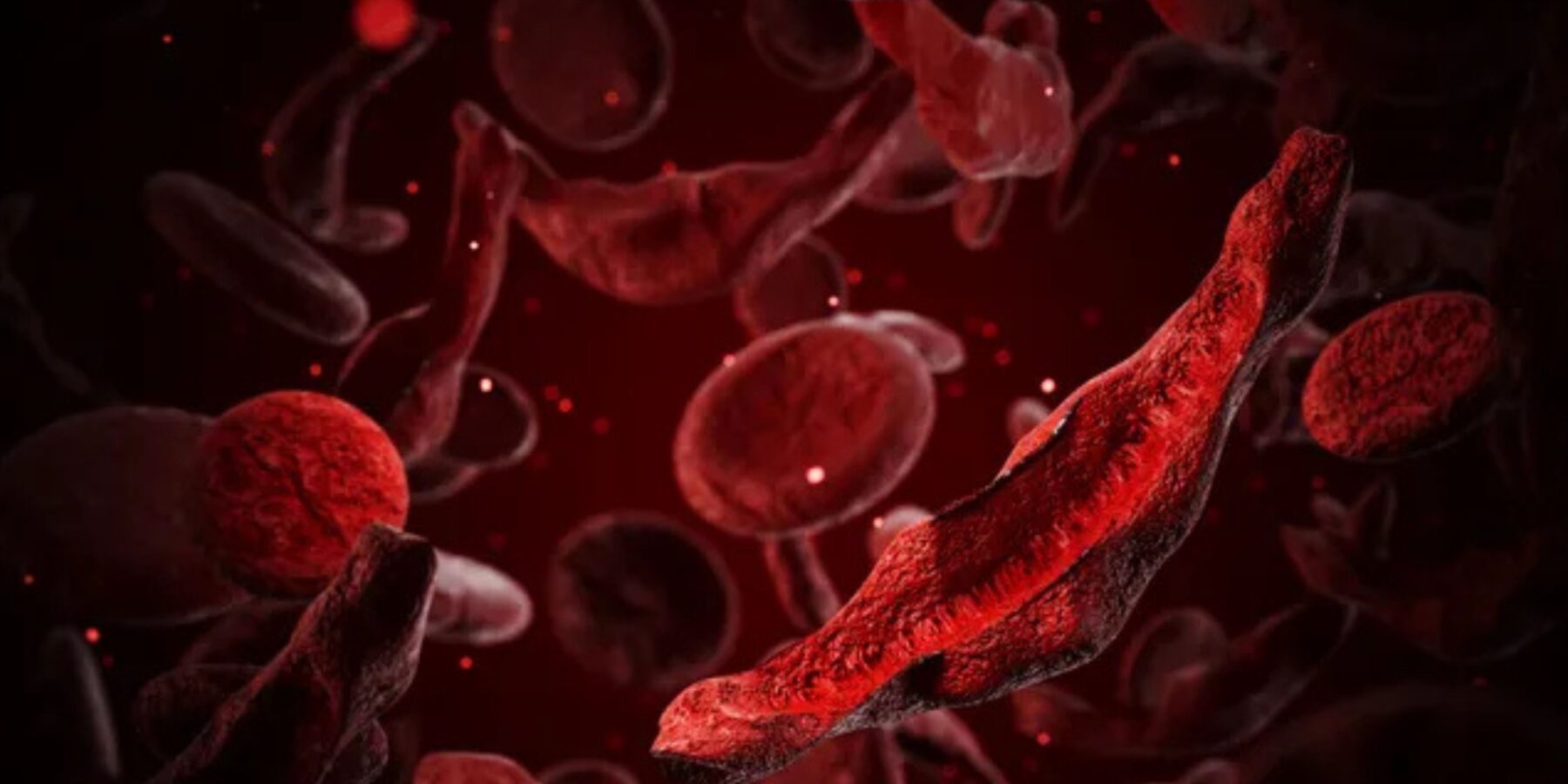 Перший CRISPR-лікування серповидноклітинної анемії: український погляд на світову сенсацію