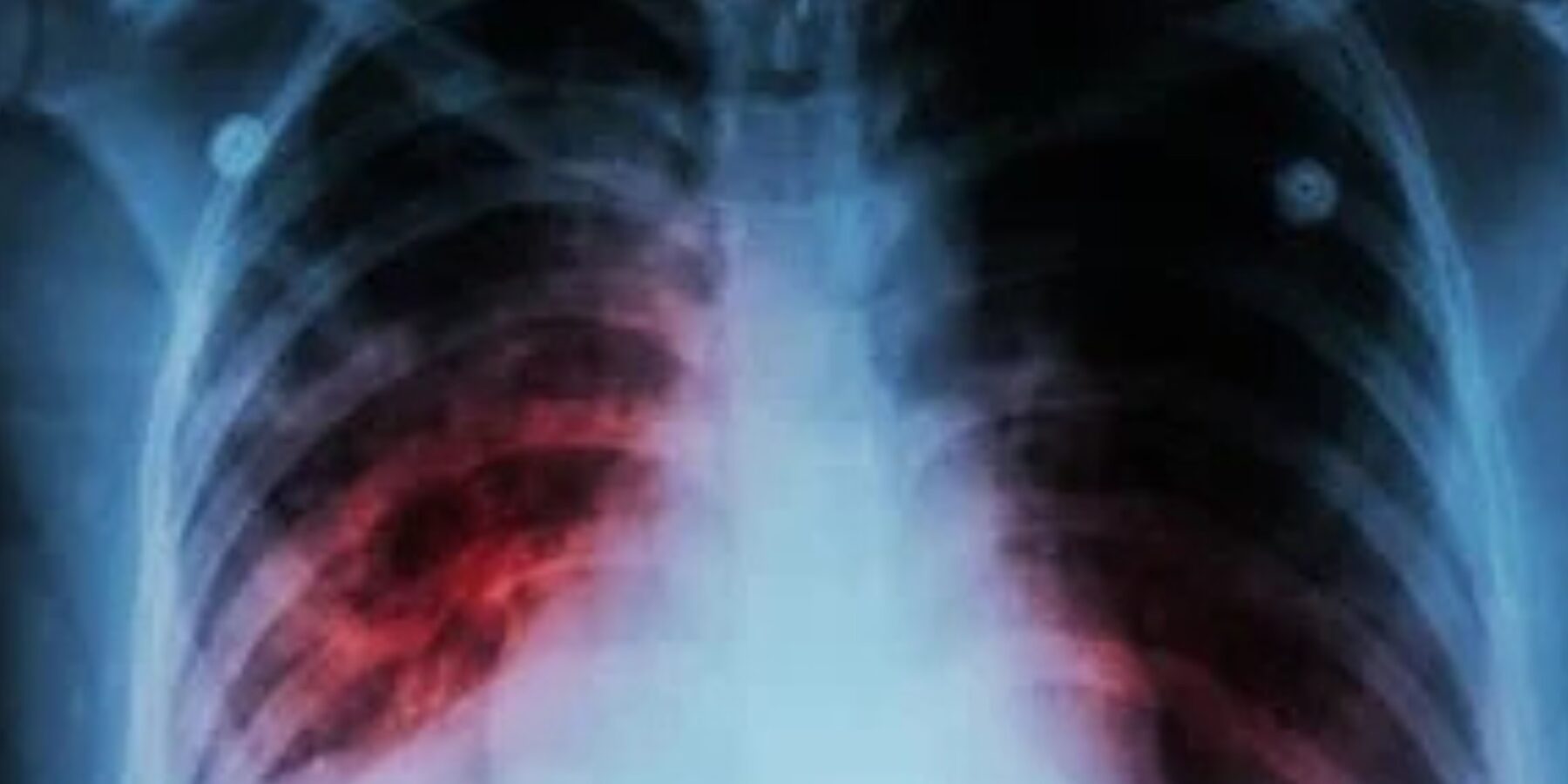 Медики наголошують: короткі курси лікування туберкульозу мають свої ризики