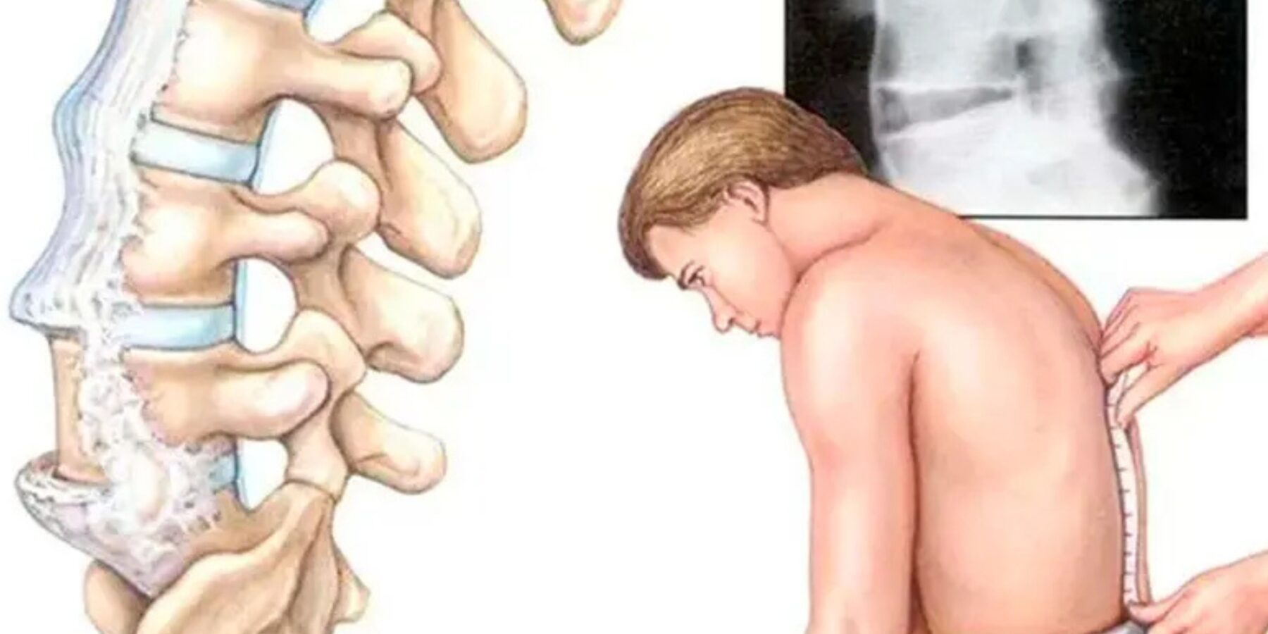 Як не пропустити початок артриту: ключові симптоми та профілактика