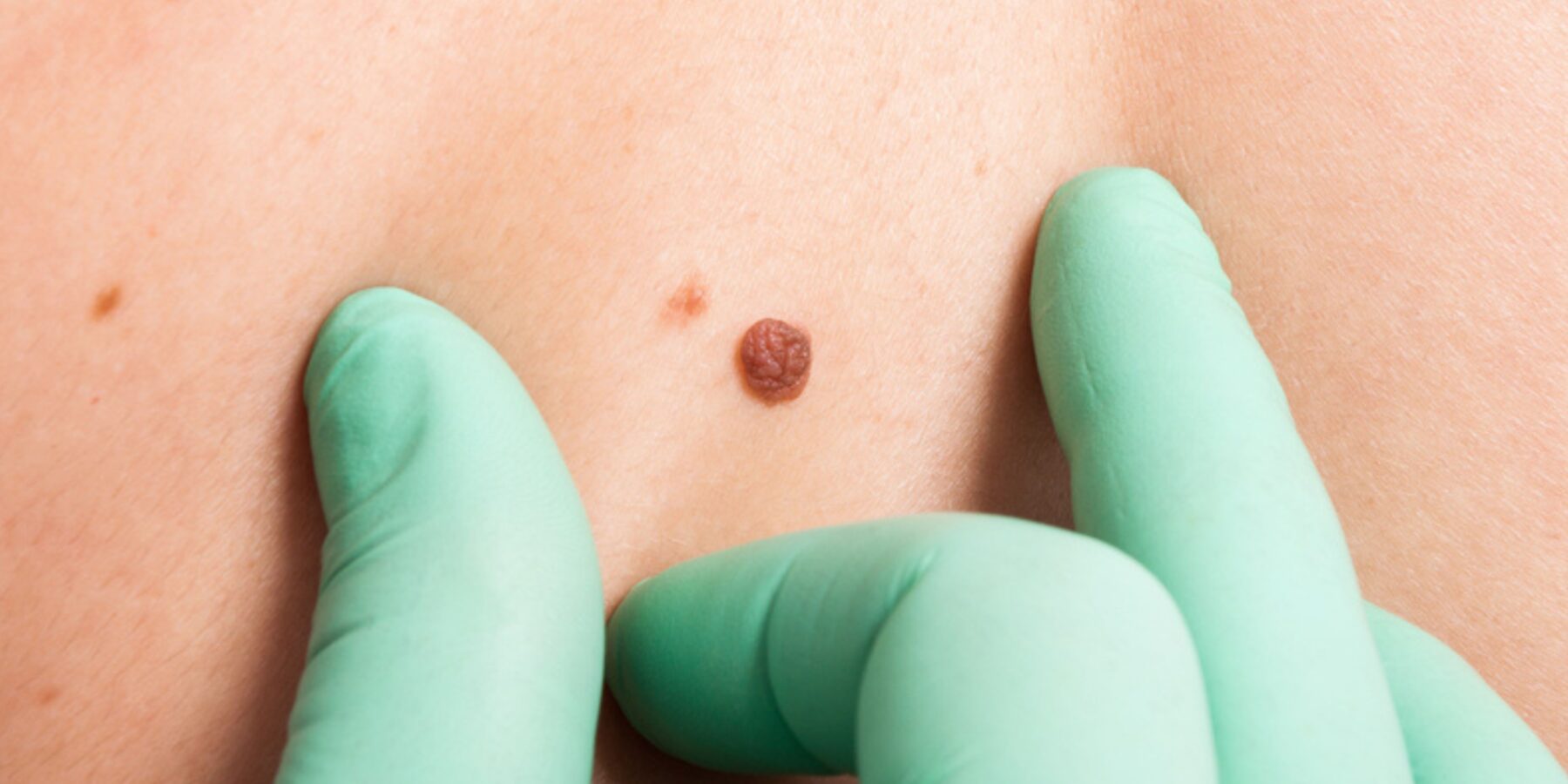 Онкологи повідомляють: меланома – тиха загроза, яку можна перемогти